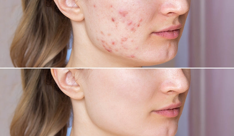 Brufoli da stress, ecco come liberarsene e tornare a splendere